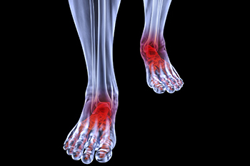 Arthritic foot and ankle care treatment in the Burlington County, NJ: Marlton (Evesham, Medford, Maple Shade) and Delran (Moorestown, Cinnaminson, Lumberton, Mt Holly, Willingboro), and Camden County, NJ: Glendale, Haddonfield, Waterford, Cherry Hill, Voorhees, Pennsauken areas